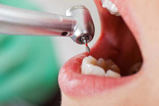 Best Knocked-Out Tooth (Avulsed Tooth) Treatment in Halsey, OR